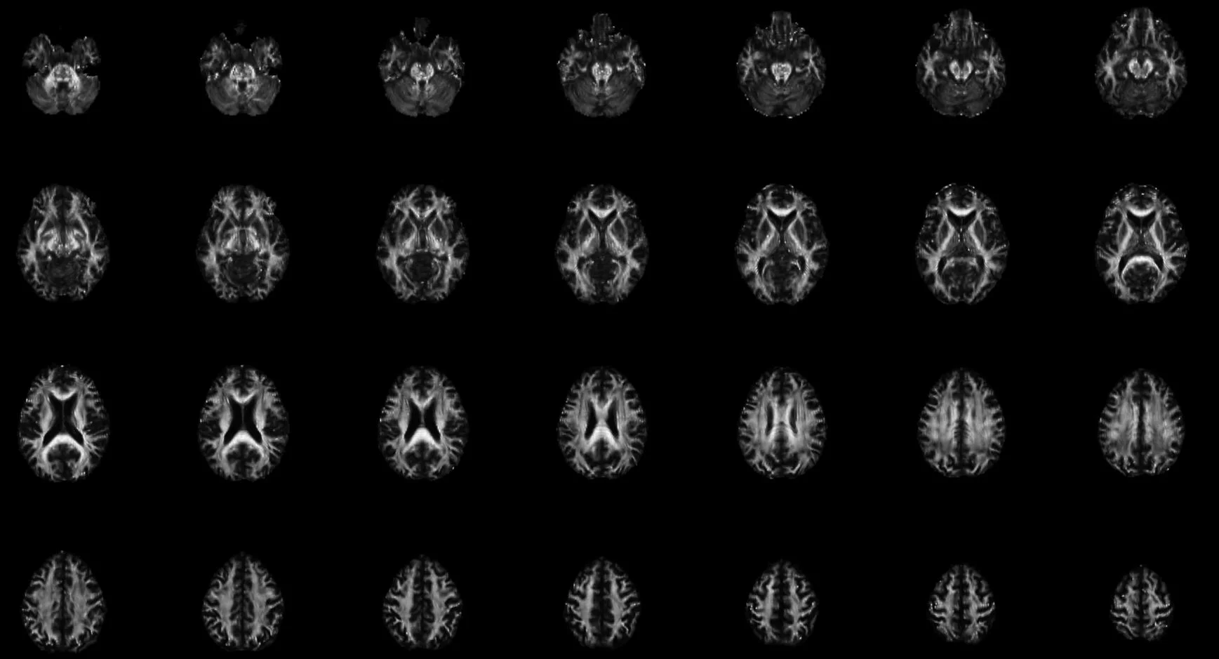 MRI-DTI diffusion tensor image of brain white-matter tracts