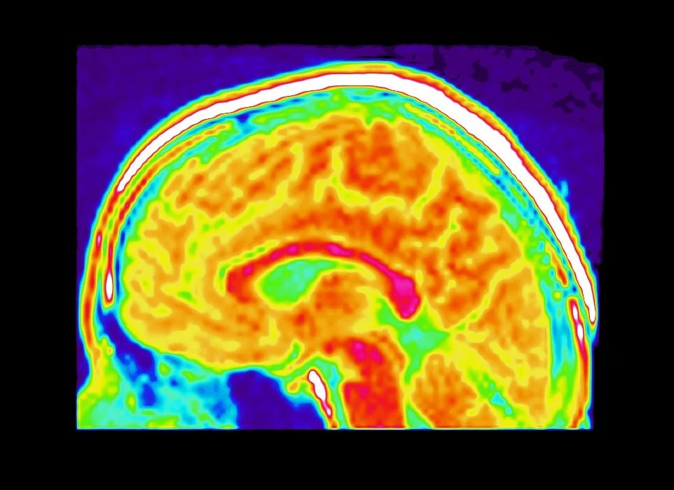 PET brain scan showing regional metabolic activity