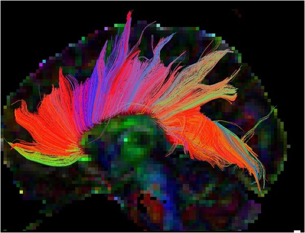 MRI-DTI tractography of brain white-matter fiber tracts in color