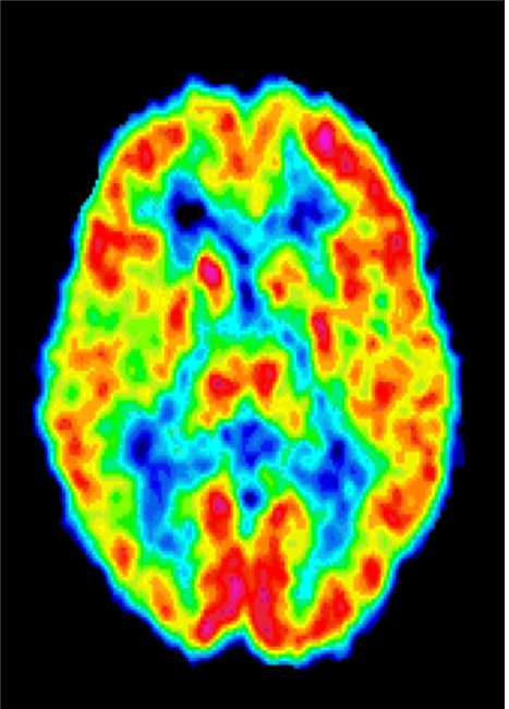 FDG-PET scan showing regional brain glucose metabolism on a color scale