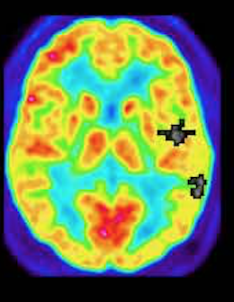 Sample PET Z-map analysis 1