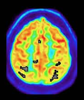 Sample PET Z-map analysis 2