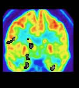 Sample PET Z-map analysis 4