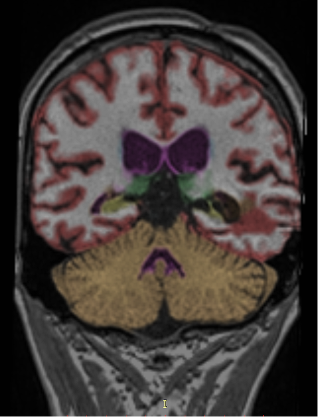 Quantitative MRI volumetric segmentation of brain structures by region